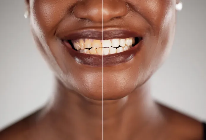Before and after dental transformation
